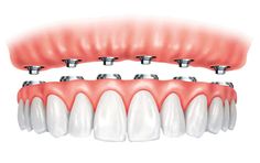 This contains an image of: Smile In a Day - Cosmetic Dental Implant Centre CDiC Wakad