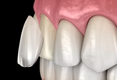 Many people desire to have a beautiful, confident smile, but unfortunately, for those with sensitive teeth, it can be a challenge. Sensitive teeth can be a result of various factors such as worn enamel, gum recession, cavities, or even teeth grinding. It’s important to address the sensitivity issue before considering any dental procedure such as veneers. At thehealthytreatments.com, we offer a range of dental procedures including Emax porcelain veneers, dental implants, crowns, and bridges.