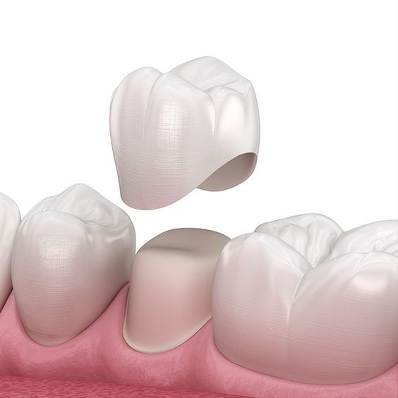 Understanding the dental crown procedure. 