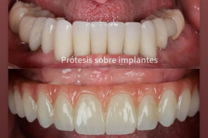 Lumix-3D Anterior Dental Implant