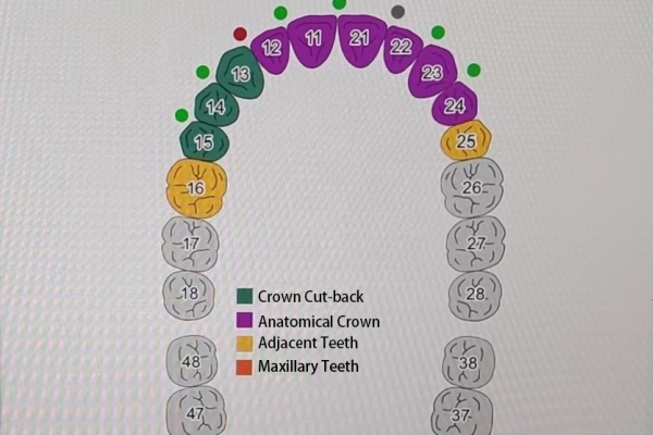 Dental Cut-back Technique