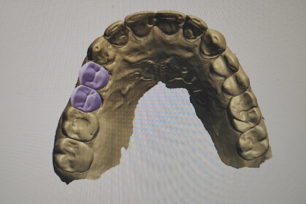 Bloomden dental CAD/CAM technology