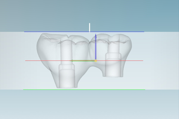 How Layout & Thickness Affect Shade —— Lumix-A3.5 Multilayer Zirconia Case Study
